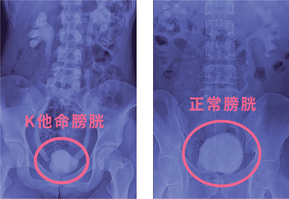 k 他命膀胱和正常膀胱對比