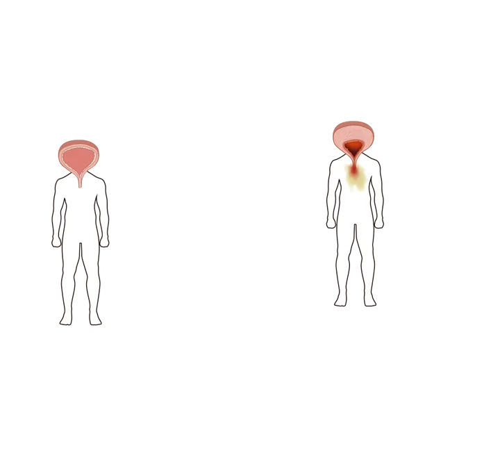 X 光圖中比較 K 他命膀胱和正常膀胱大小