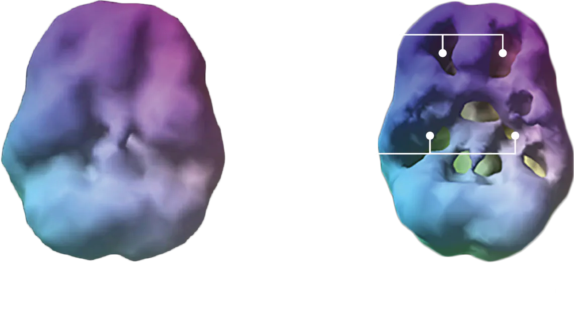 吸食大麻二年腦部對比