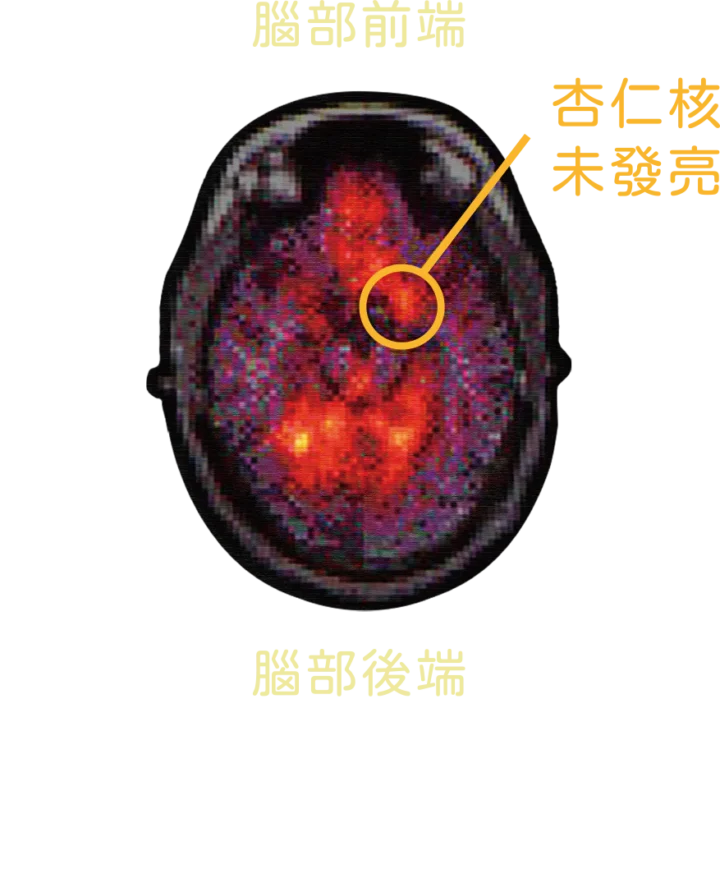 腦部杏仁核未發亮