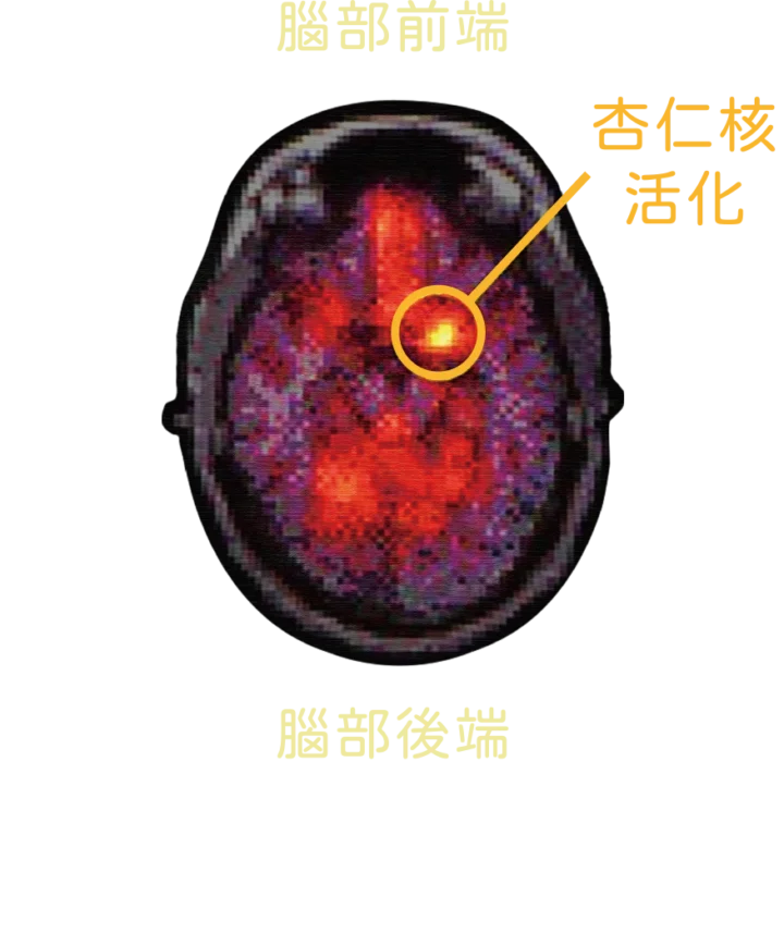 腦部杏仁核活化